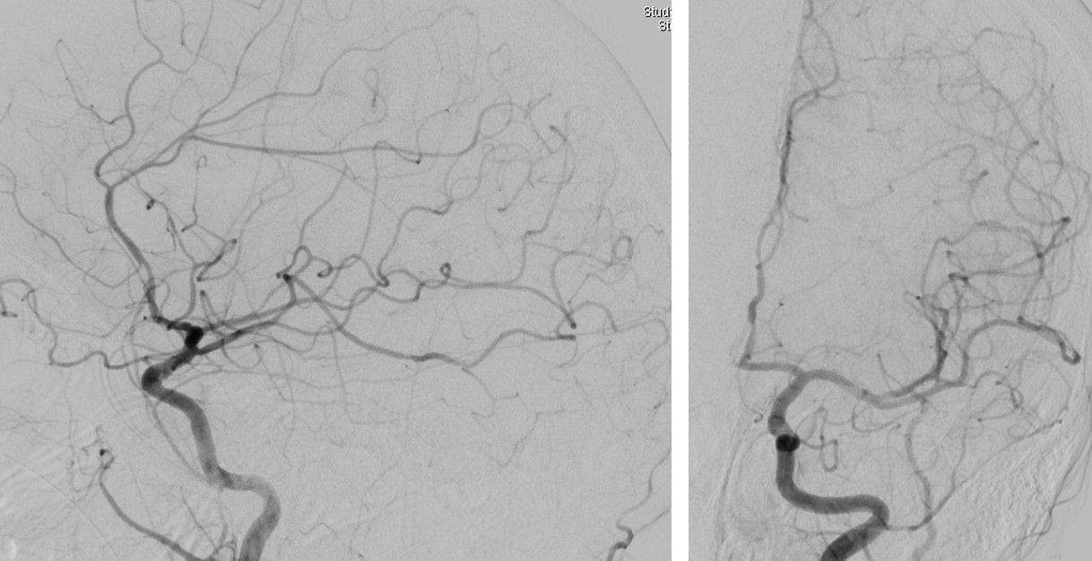 Right Radial Approach Mechanical Thrombectomy for Posterior Circulation