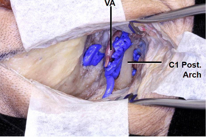 Far Lateral Approach - Congress of Neurological Surgeons (CNS)