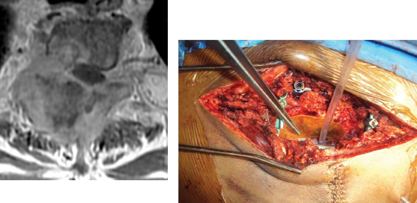 Radiation Therapy for Metastatic Spinal Tumors