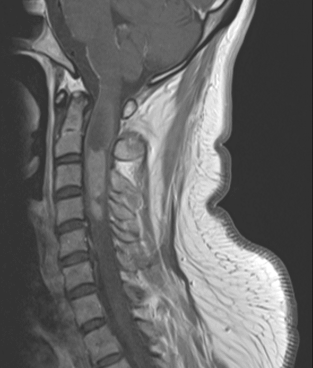 Laminectomy for Ependymoma of the Cervical Spine