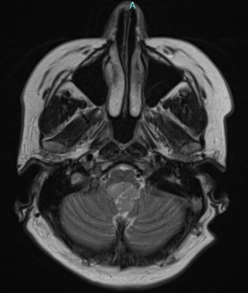 Microneurosurgery 4A ⅣA Microsurgical removal of a Fourth Ventricle Ependymoma with the