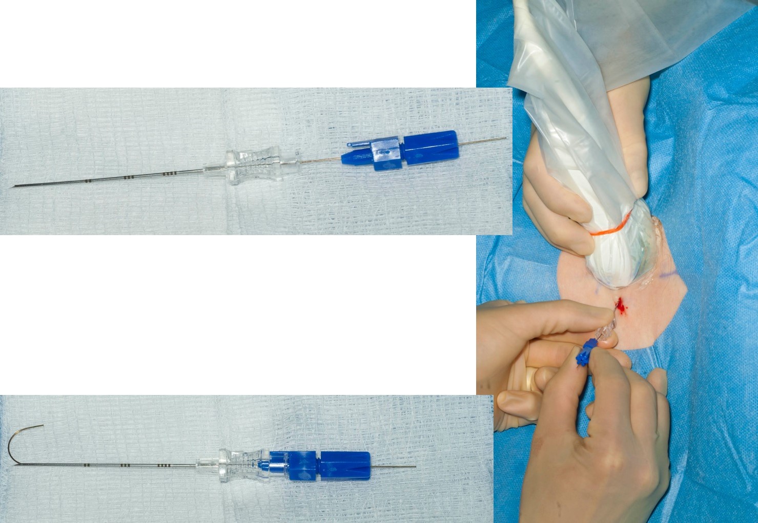 Simple Decompression and Transection for Meralgia Paresthetica - cns.org