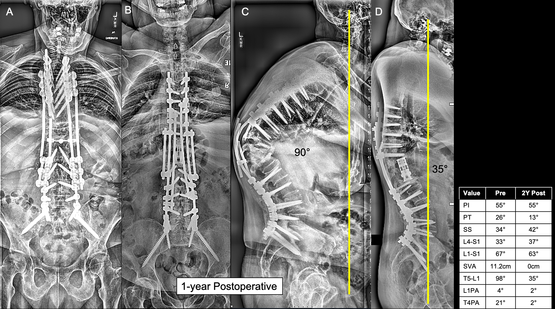 Severe Kyphotic Deformity Corrected by Three-Level Vertebral