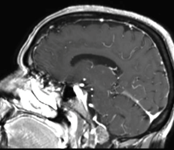 foramen magnum mri