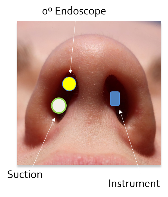 Endoscopic Endonasal Transsphenoidal Resection Of A Non-functioning ...