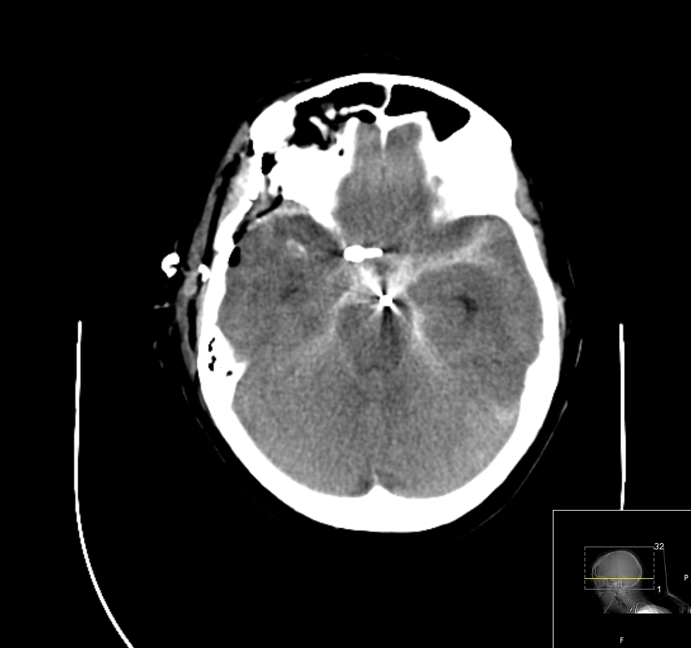 Right OZ for clipping MCA aneurysm - Congress of Neurological