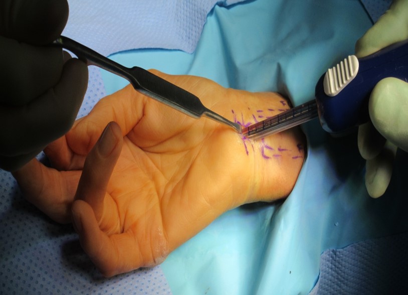 Endoscopic Carpal Tunnel Release Surgery for Carpal Tunnel Syndrome 