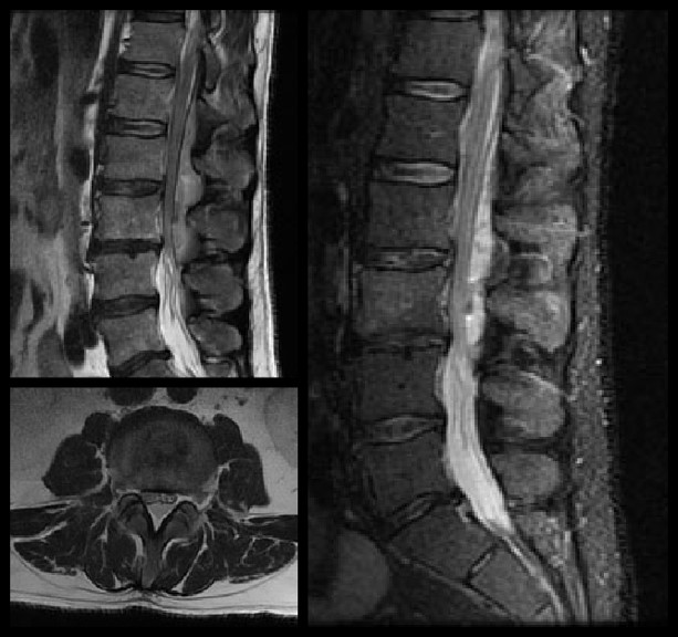 Lumbar Laminectomy with Irrigation and Debridement of Lumbar Epidural ...