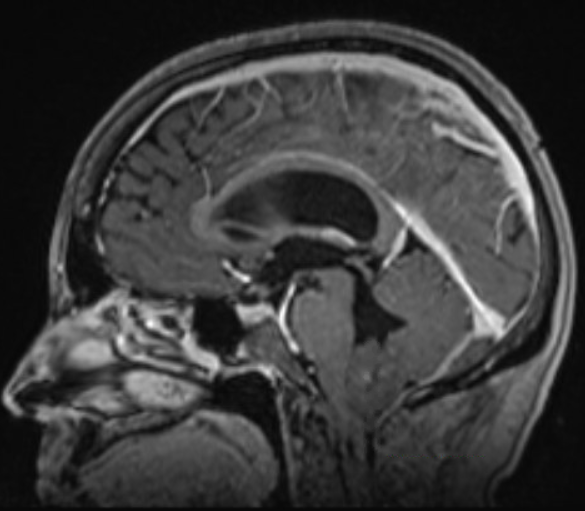 Microsurgical removal of a Fourth Ventricle Ependymoma with the