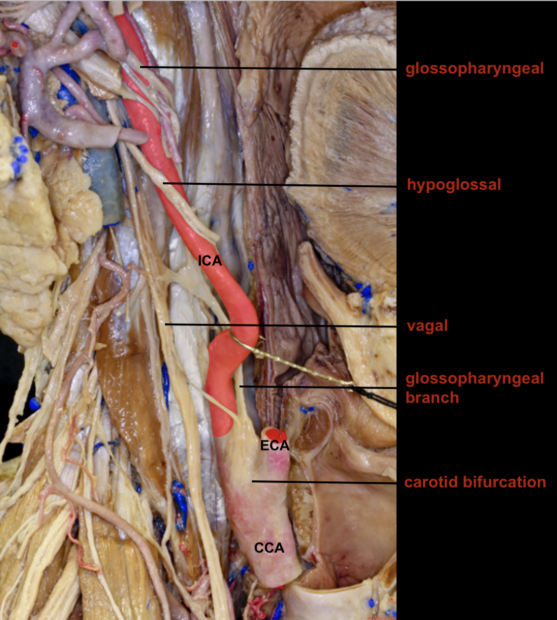 Left Carotid Endarterectomy Cea For Symptomatic Stenosis Cns Org