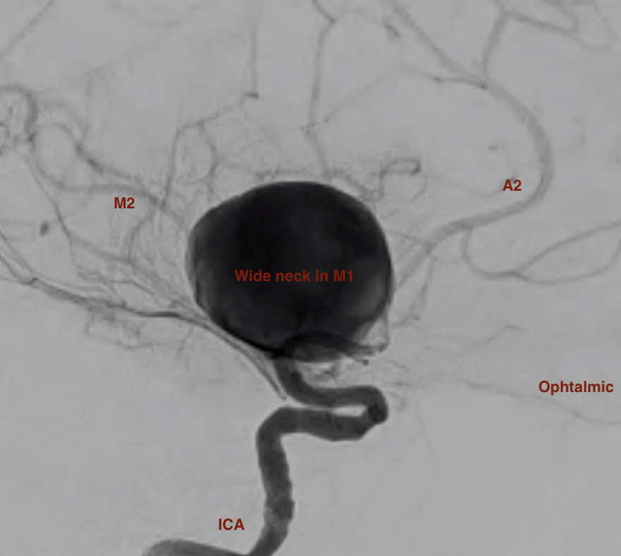 Flow diverter device placement for an unruptured M1 giant aneurysm