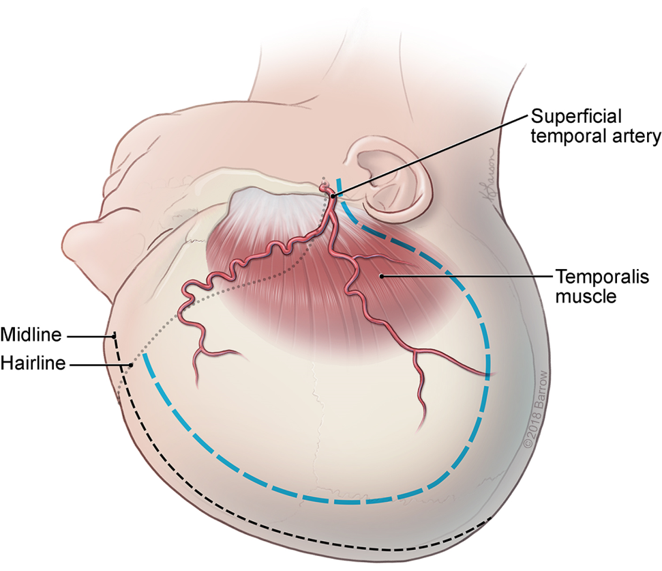 Trauma Flap Decompressive Hemicraniectomy  Neupsy Key