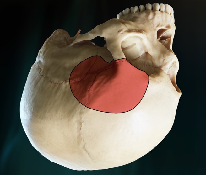 Left OZ craniotomy for medial sphenoid wing meningioma