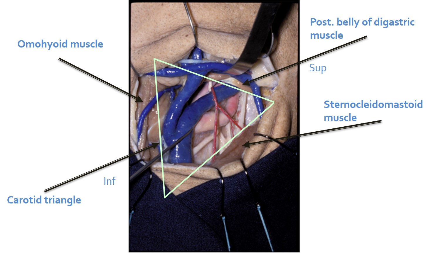 Carotid Endarterectomy For Symptomatic Carotid Stenosis