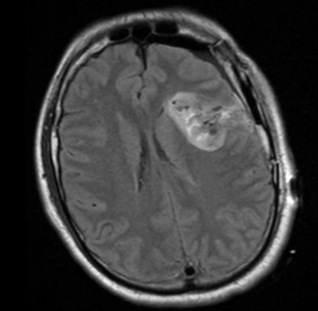 Trans-Sylvian Approach for Resection of Insular Glioma. - cns.org