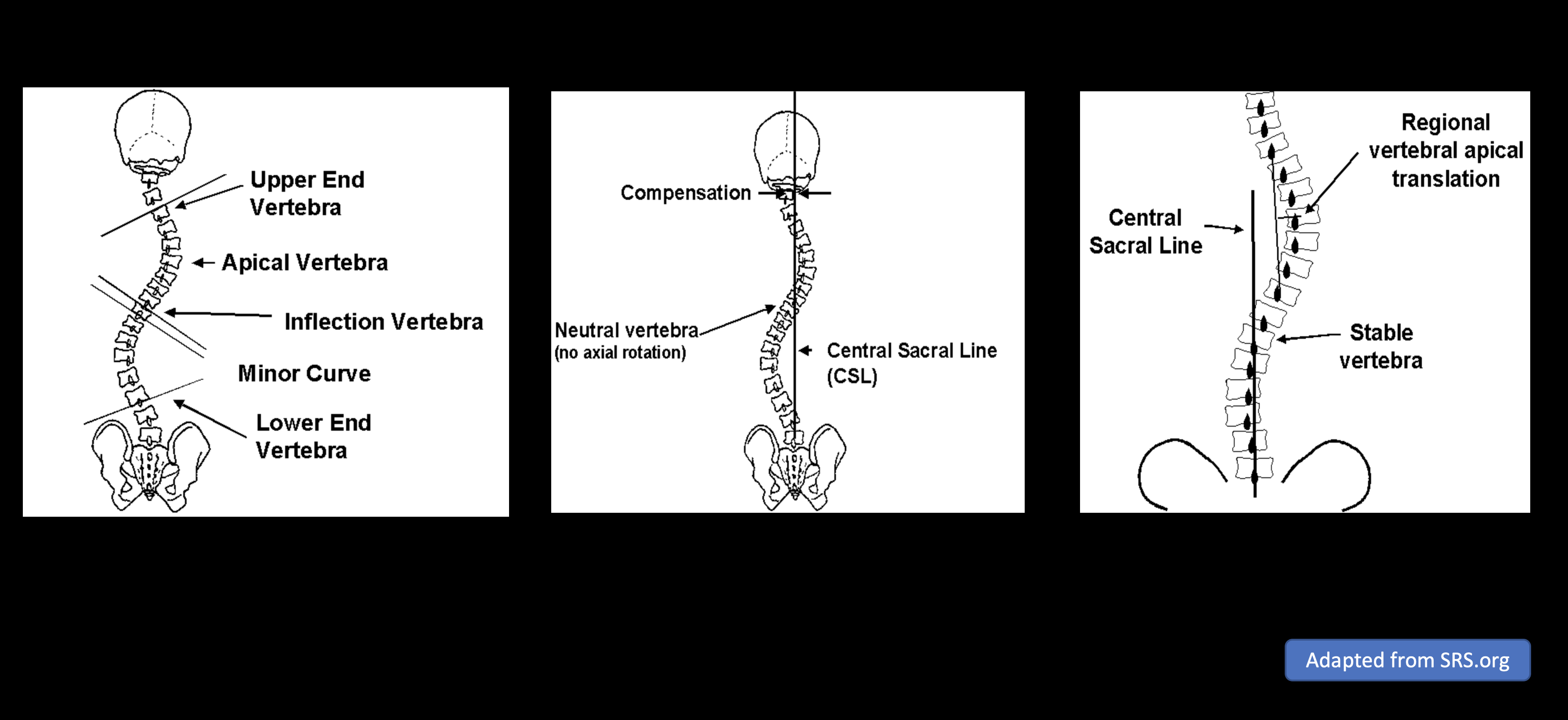 Surgical Correction of Lenke 1C Adolescent Idiopathic Scoliosis - cns.org