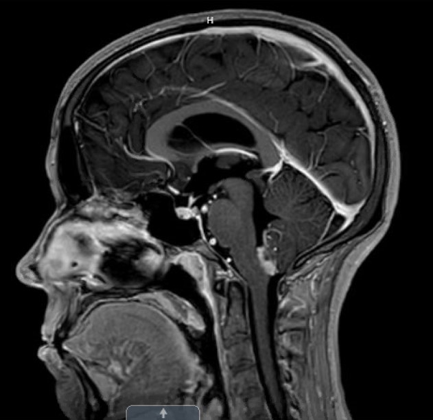 Suboccipital craniotomy with C1 laminectomy for resection of 4th ...