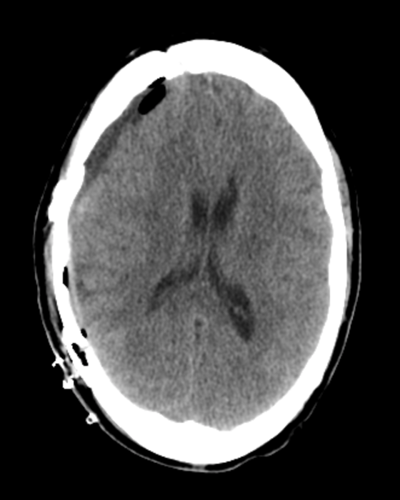 Right Decompressive Hemicraniectomy for Acute Traumatic Subdural ...