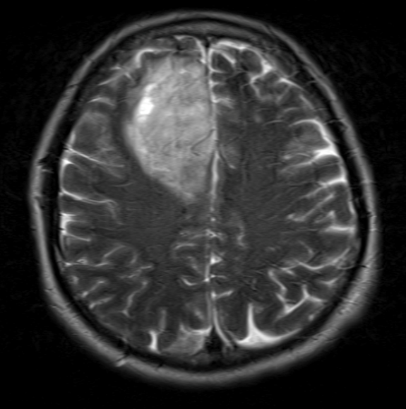 Right Frontal Craniotomy for Glioma - Congress of Neurological