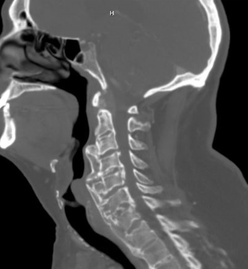 cervical osteophytes and swallowing