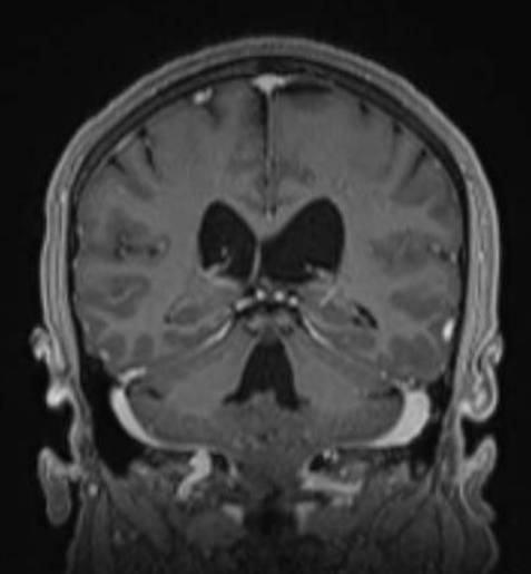 Microneurosurgery 4A ⅣA Microsurgical removal of a Fourth Ventricle Ependymoma with the