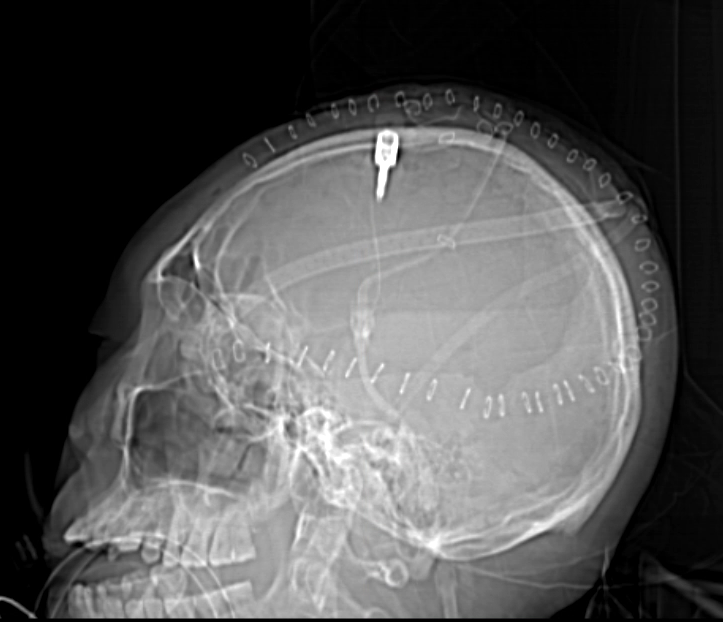 Left Decompressive Hemicraniectomy and Barbiturate Coma for ICP Control ...