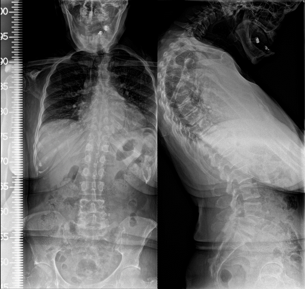 Chinonchest deformity in female with cervicothoracic kyphosis