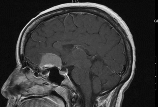 Replacement Brain and Skull Cap for Neuroendoscopic Surgery