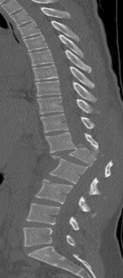 Open Reduction of Thoracolumbar Fracture Dislocation - Congress of