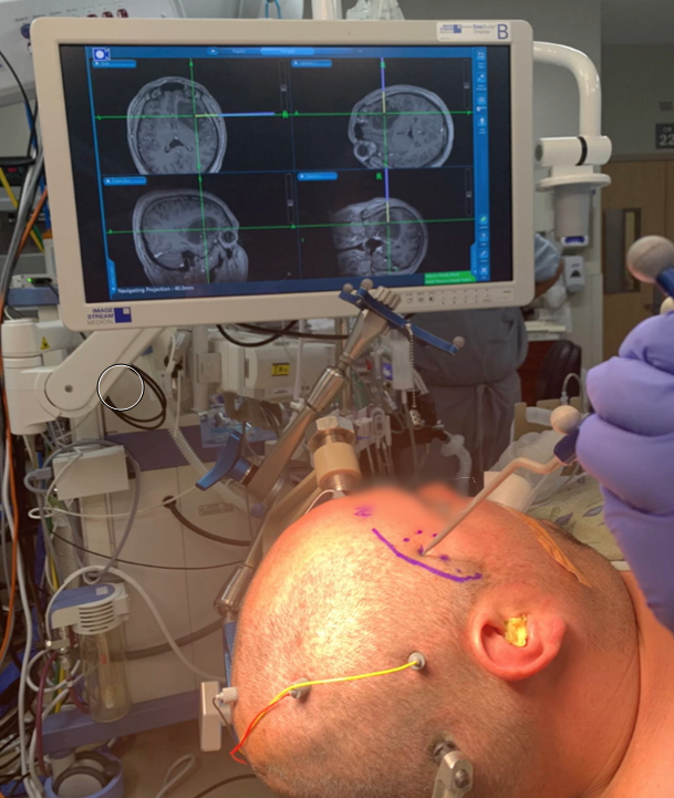 Mini-Pterional Approach For Insular Tumors - Cns.org