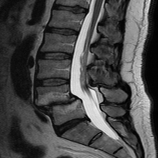 Posterolateral interbody fusion with correction of spondylolisthesis ...