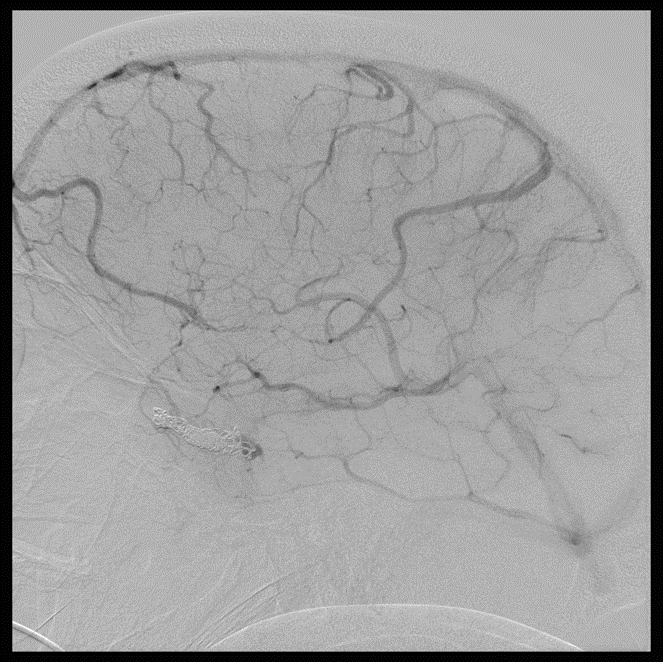 Endovascular Embolization And Coiling Of A Right Carotid Cavernous