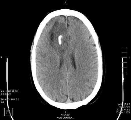 Right Frontal Craniotomy for Glioma - Congress of Neurological