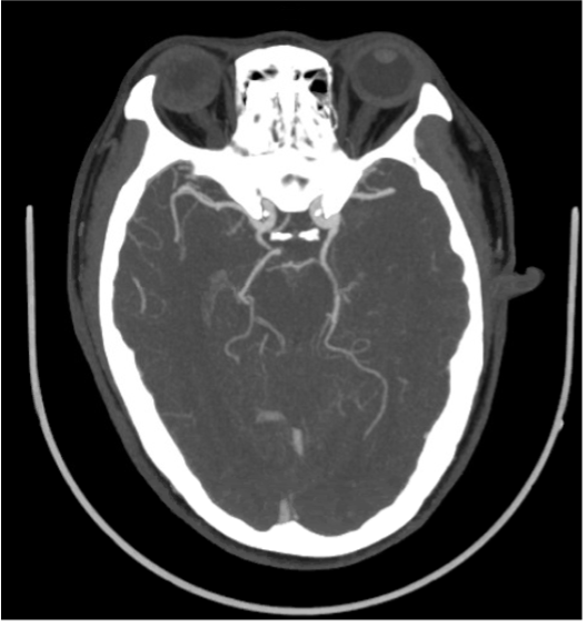 Pcom Radiology Pcom Aneurysm | Arteria communicans posterior – ADETVC