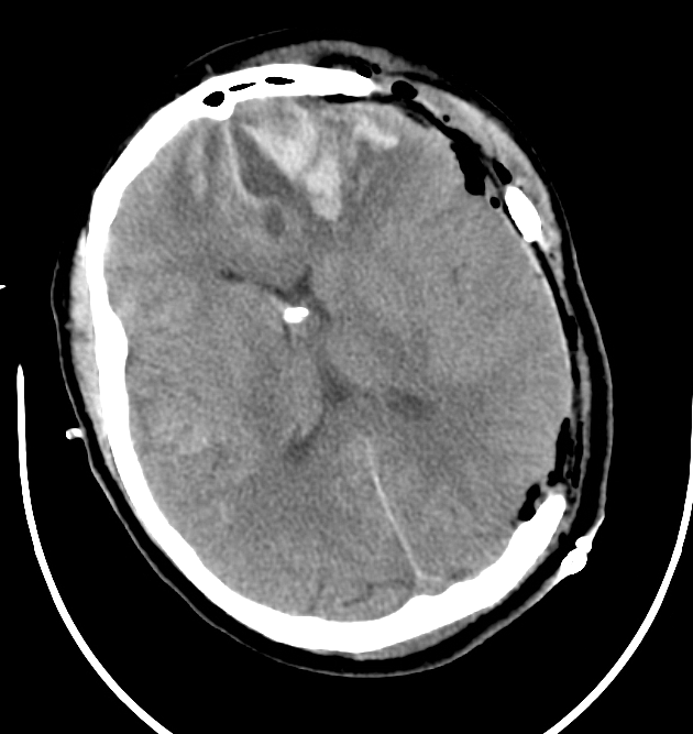 Left Hemicraniectomy and Barbiturate Coma for ICP Control