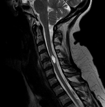 Intramedullary Spinal Cord Ependymoma And Astrocytoma Intraoperative