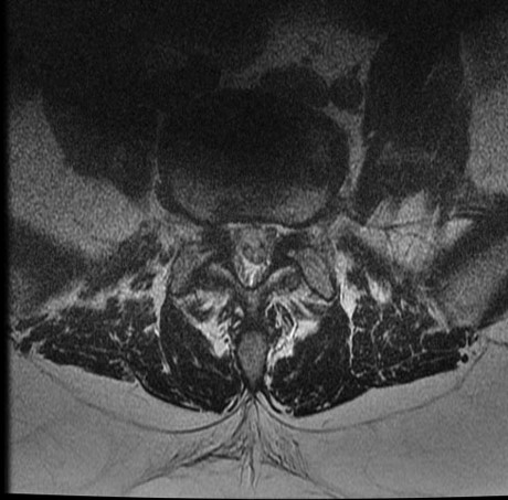 Anterior lumbar interbody fusion for chronic low back pain due to L5-S1 ...