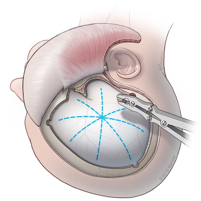 Trauma Flap Decompressive Hemicraniectomy - ScienceDirect