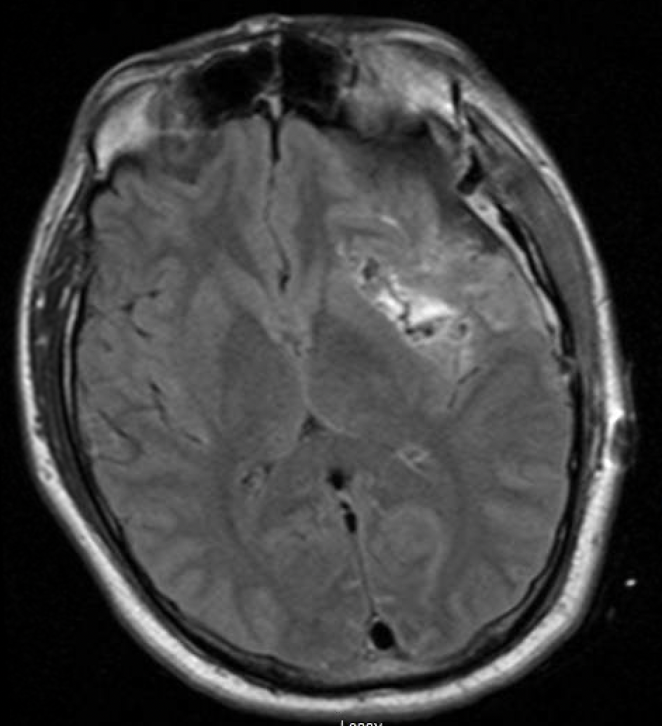 Trans-Sylvian Approach for Resection of Insular Glioma. - cns.org