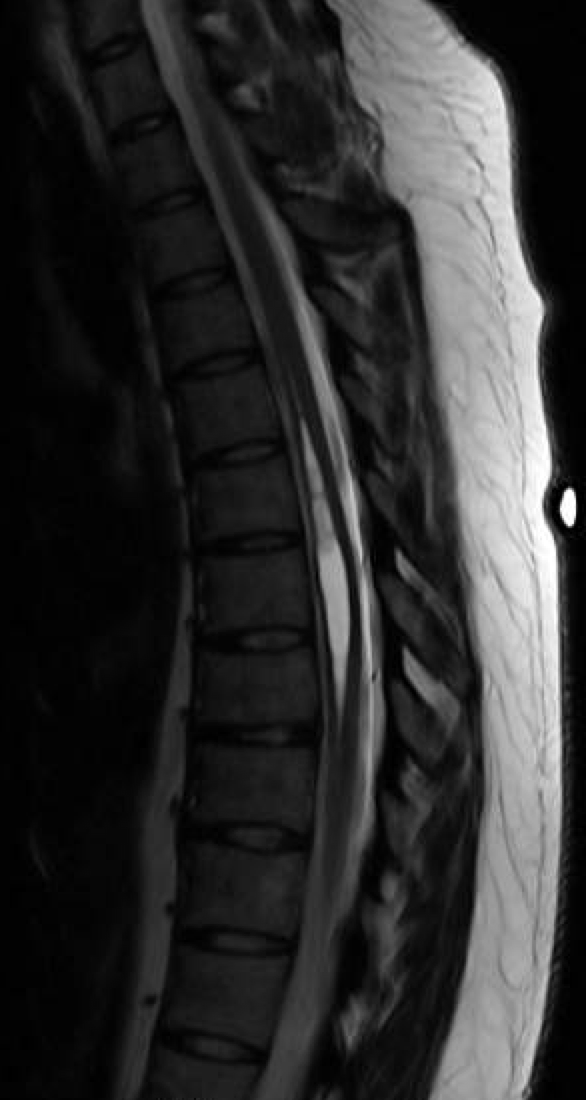 Syrinx Subarachnoid Shunt of the Thoracic Spinal Cord