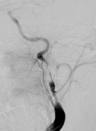 Carotid artery disease | Altru Health System