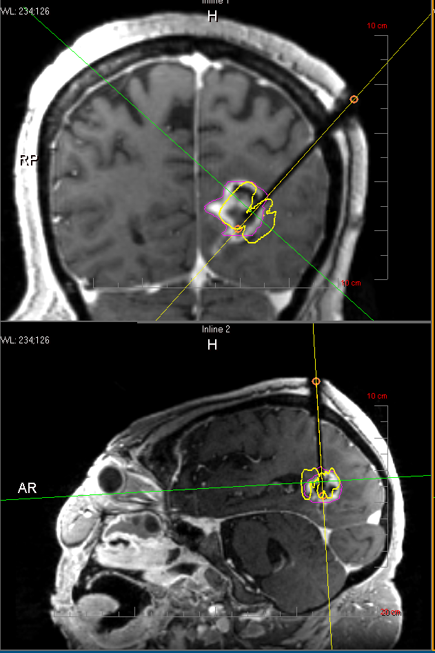 新 NS NOW Neurosurgical ReOperations 新 NS NOW Neurosurgical ReOperations Morphological analysis