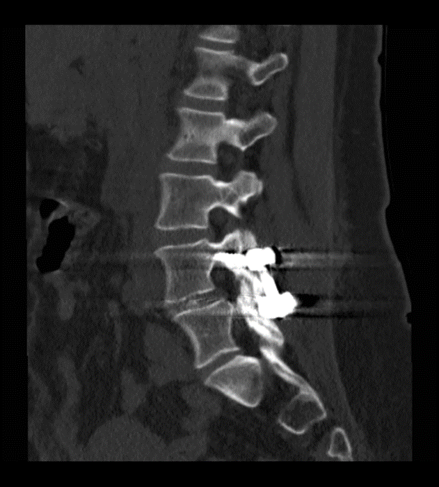 MIS TLIF with Stereotactic Navigation for L4/5 Synovial Cyst with
