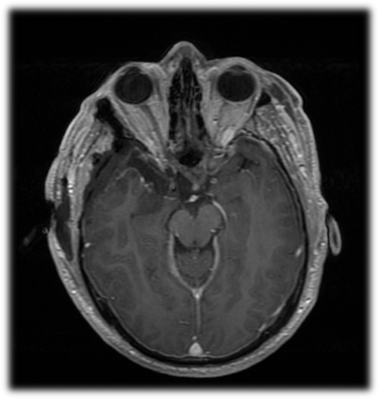 Right Modified Oz Craniotomy For Medial Sphenoid Wing Meningioma - Cns.org