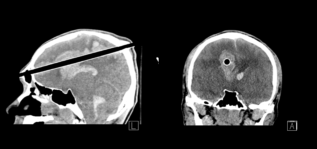 Hemicraniectomy for Skull Injury