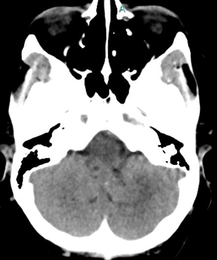 Microsurgical removal of a Fourth Ventricle Ependymoma with