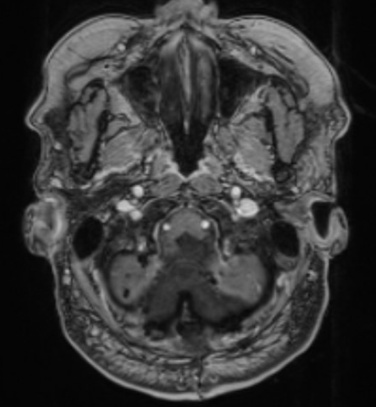 Microneurosurgery 4A ⅣA Microsurgical removal of a Fourth Ventricle Ependymoma with the