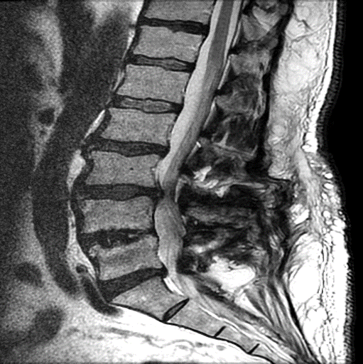 Lateral lumbar interbody fusion for adjacent segment disease - cns.org