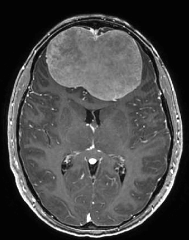 Bifrontal Craniotomy For Anterior Skull Base Meningioma 