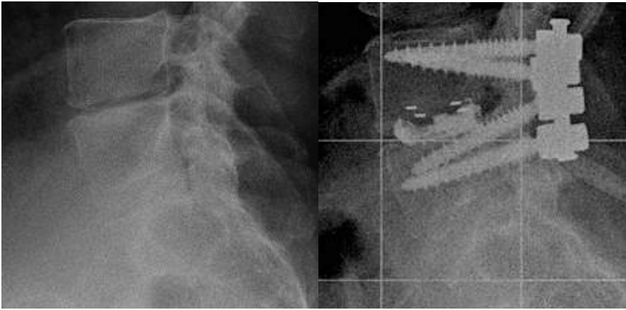 Open Transforaminal Lumbar Interbody Fusion (TLIF) For Recurrent Disc ...